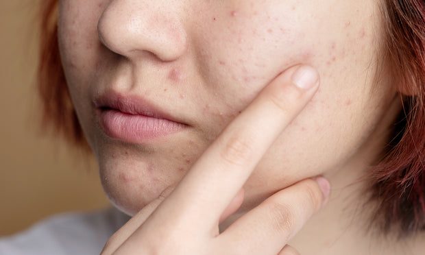 <h4>ACNE AND SKIN PROBLEMS</h4>